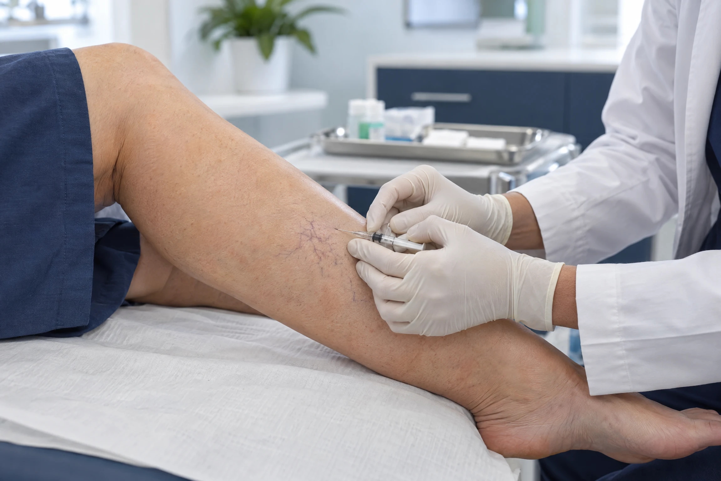 Médico realizando escleroterapia en pierna de paciente, inyección en vena varicosa